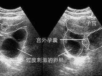 试管婴儿长计划需要多少天？试管婴儿微刺计划是什么？